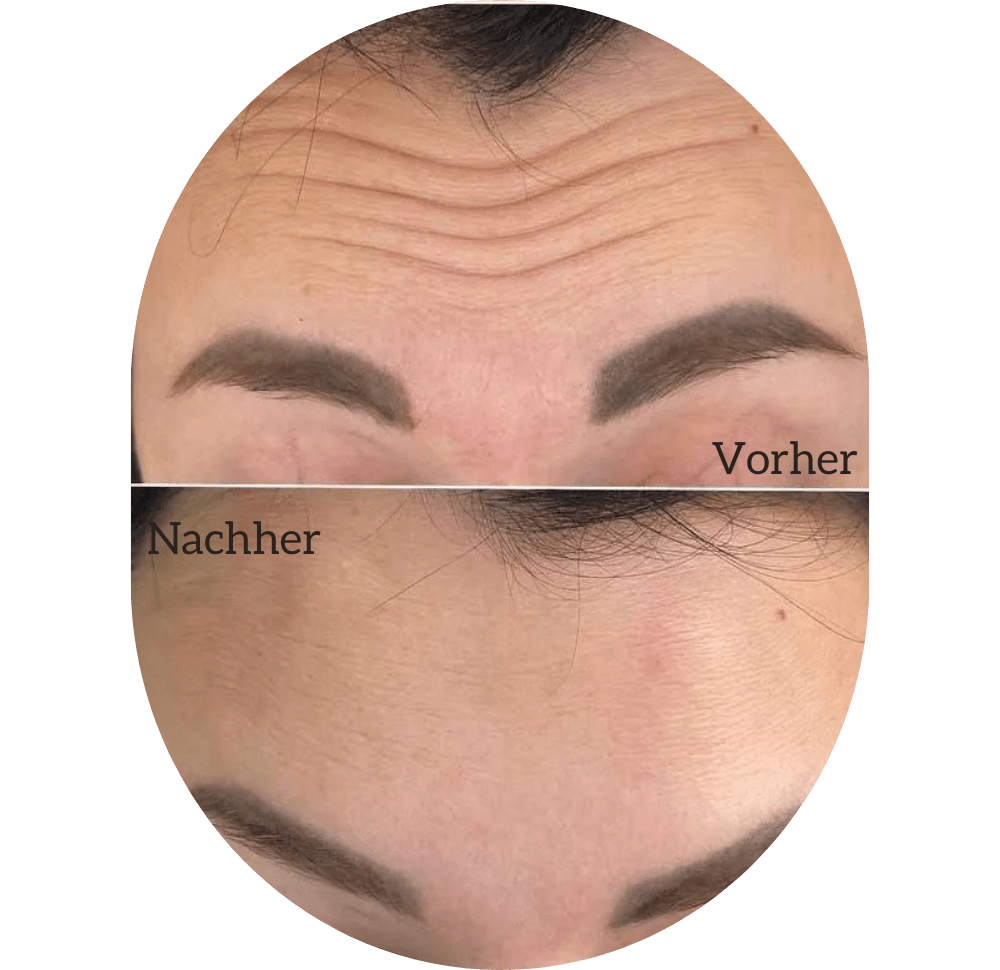 Botox Injektionen Lahr