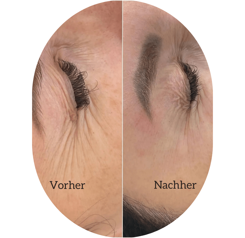Botox Injektionen Lahr
