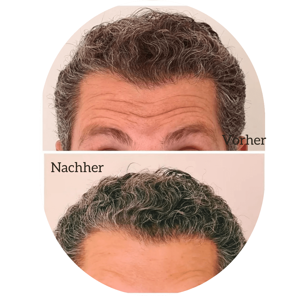 Botox Injektionen Lahr
