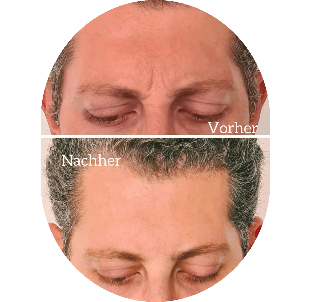 Botox Injektionen Lahr