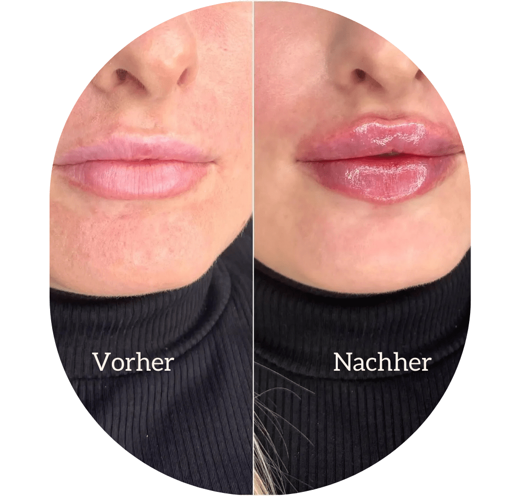 Hyaluronsäure Behandlungen
