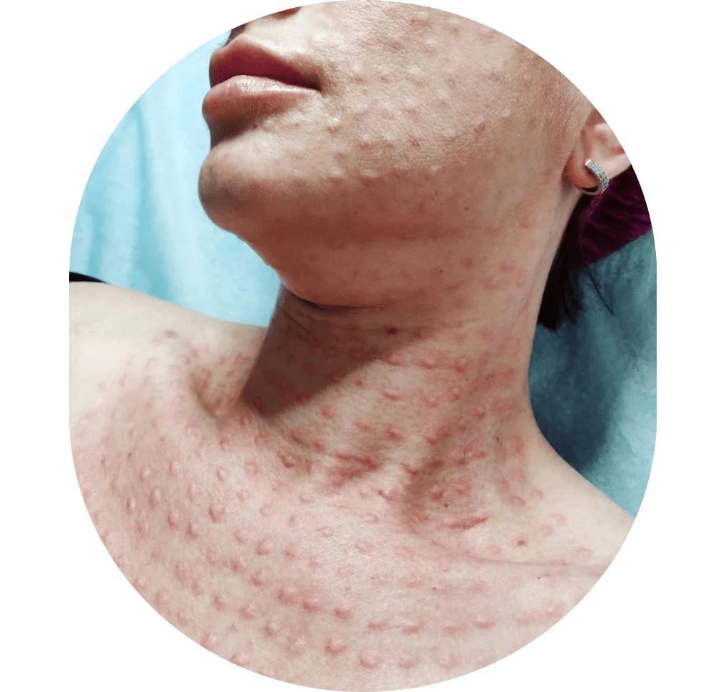 Mesotherapie / Revitalisierung / Lipolyse