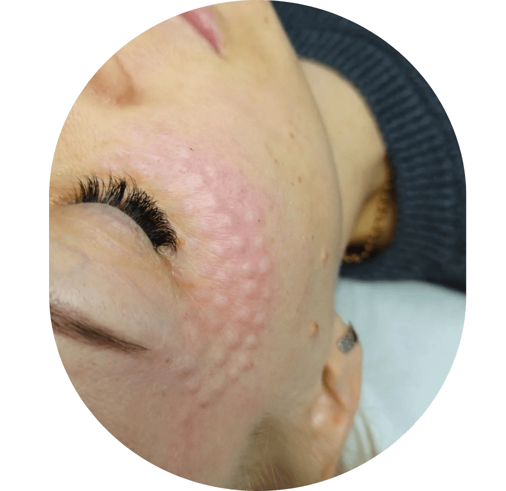 Mesotherapie / Revitalisierung / Lipolyse