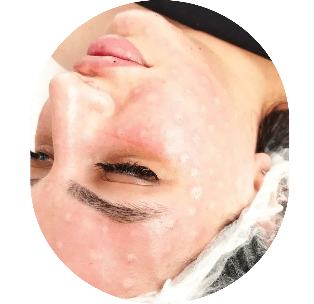 Mesotherapie / Revitalisierung / Lipolyse