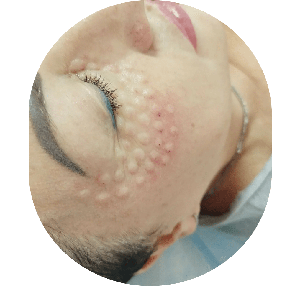 Mesotherapie / Revitalisierung / Lipolyse