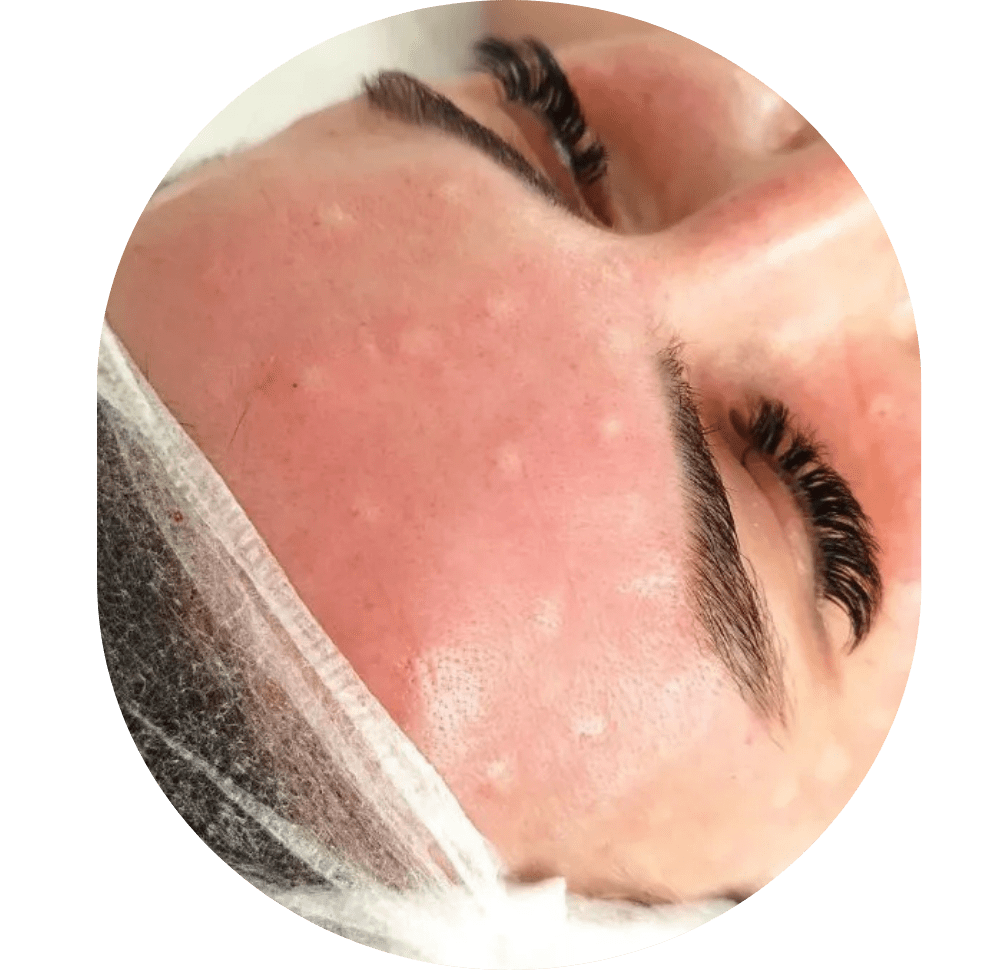 Mesotherapie / Revitalisierung / Lipolyse
