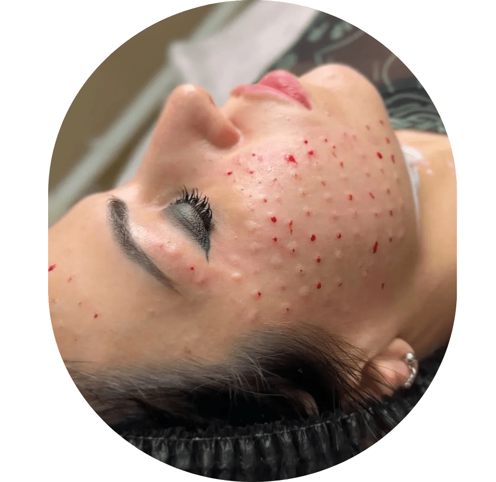 Mesotherapie / Revitalisierung / Lipolyse