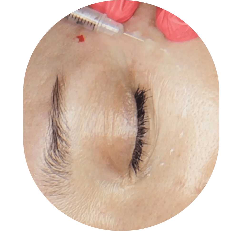 Mesotherapie / Revitalisierung / Lipolyse